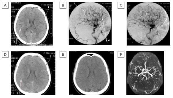 Figure 1: Patient H., 60 years old, female, suffered a small ischaemic stroke in the right hemisphere resulting in partial left-sided hemiparesis.