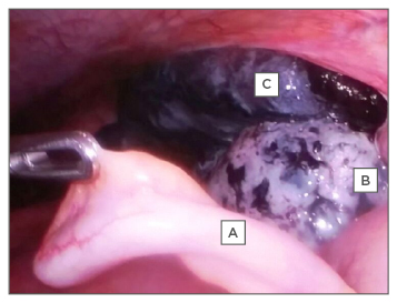 Laparoscopic Oophorectomy for Ovarian Torsion • Video •