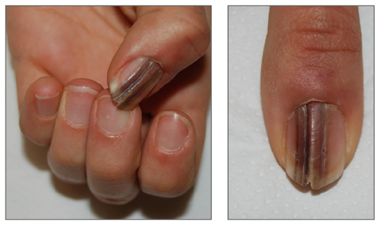 Dark line on nail - January 2019 Babies | Forums | What to Expect