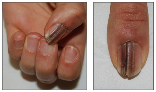 Cureus | Fungal Melanonychia as a Solitary Black Linear Vertical Nail Plate  Streak: Case Report and Literature Review of Candida-Associated  Longitudinal Melanonychia Striata | Article