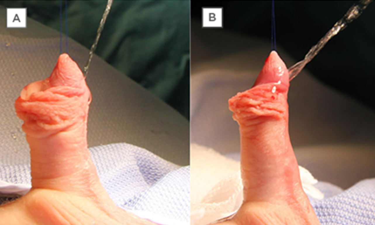 One-stage repair of proximal hypospadias with severe chordee by in situ  tubularization of the transverse preputial island flap - Journal of  Pediatric Urology, image size:1283x769