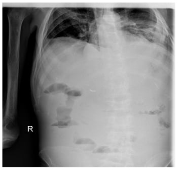 Figure 1: Abdominal X-ray showing elevation of the right haemidiaphragm as a result of the enlarged liver.