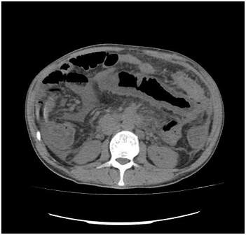 Figure 2: CT evaluation of the abdomen revealed bowel distention, thickening of the intestinal wall, and thumbprinting, indicative of ischaemic bowel disease.