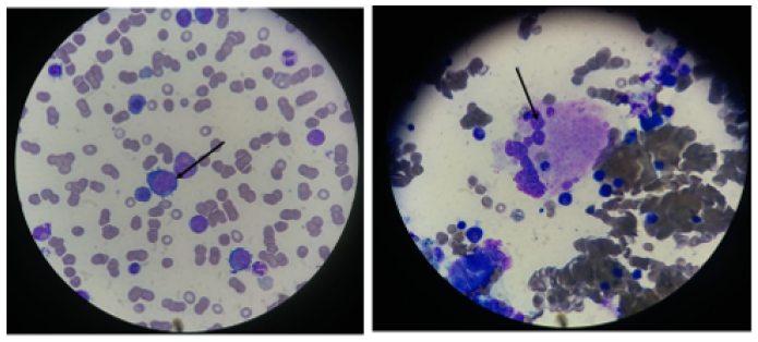 Figure 2: Bone marrow biopsy displaying megablastosis.