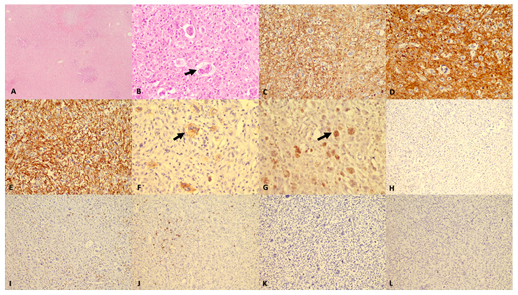 Figure 2: Histomorphology and immunohistochemistry findings.