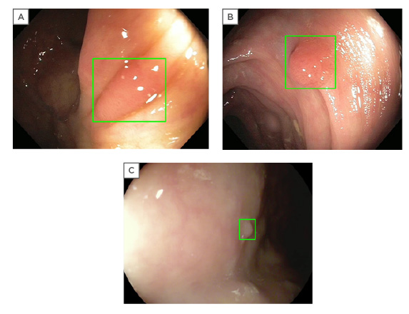 Key performance measures for colonoscopy: potential role of artificial intelligence