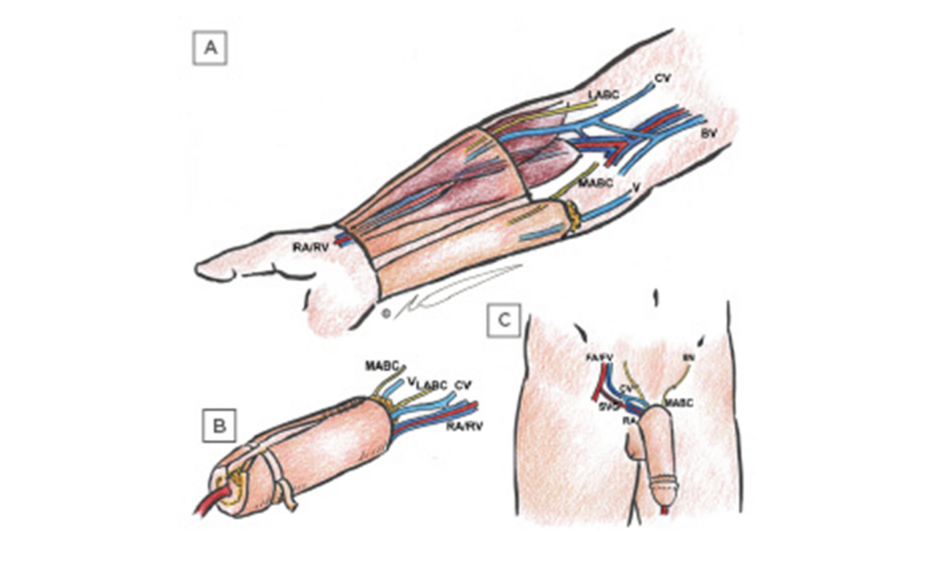 Growing Bone: Lengthening and Grafting | SpringerLink