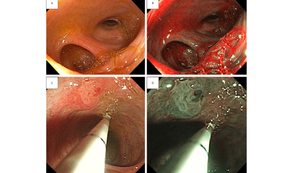 Cholangioscopy and its Role in Primary