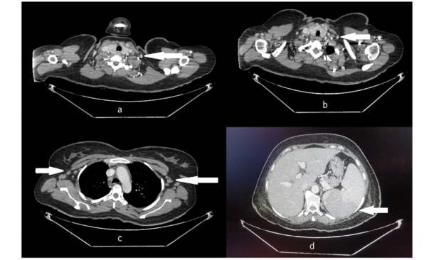 Adult-Onset Still’s Disease Complicated with Haemophagocytic