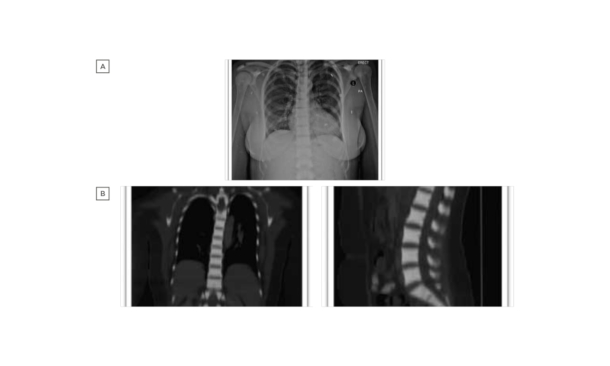 Pancytopenia Secondary to Adult Osteopetrosis