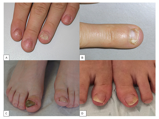 There is residual nail bed psoriasis under methotrexate therapy.... |  Download Scientific Diagram