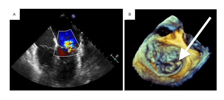 Figure 2 An intraoperative transesophageal echocardiogram demonstrating mitral regurgitation on midesophageal four-chamber view (A) as well as a 3-dimensional transthoracic echocardiogram showing a flail posterior leaflet