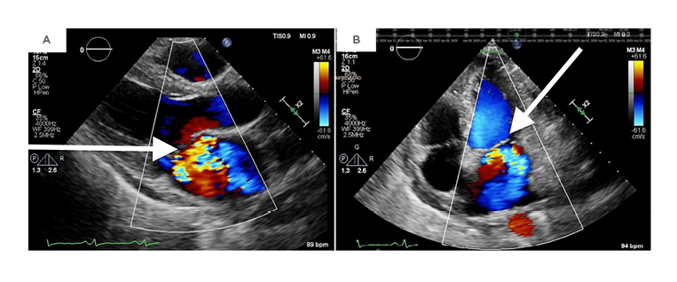 Figure 1 A repeat transthoracic echocardiogram revealing severe mitral regurgitation in the parasternal long-axis view
