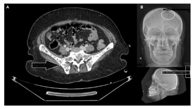 Figure 1 Lytic bone lesions over the pelvic girdle (A) and skull (B)