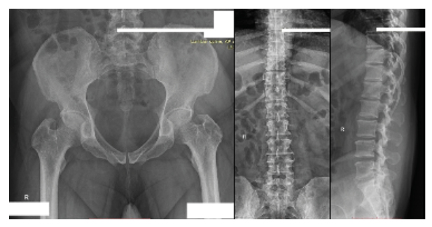 Figure 2 Normal lumbosacral spine and pelvic X ray