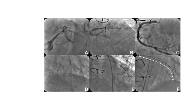 Percutaneous Transcatheter Metabolic ft image