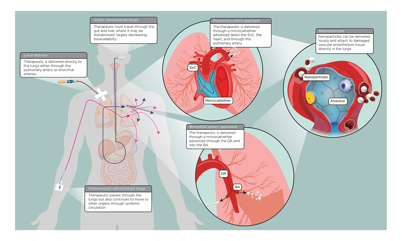 Pulmonary Artery Lung