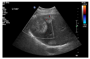 Figure 1 Ultrasound image of the liver showing multiple