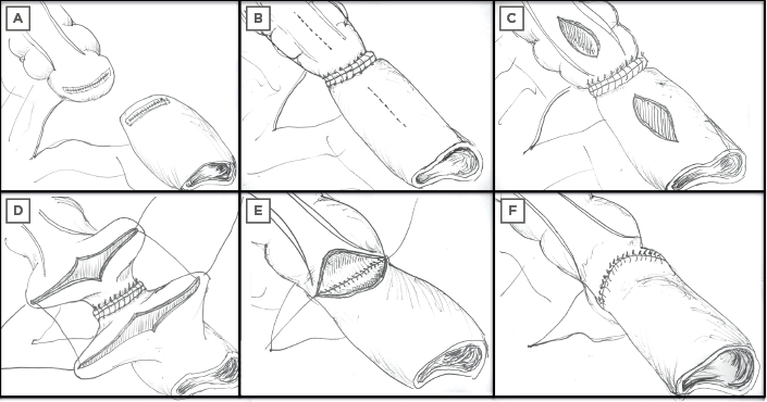 Figure 2 Steps involved in the construction of a Kono-S anastomosis. The mesentery of the resected segment remains in situ
