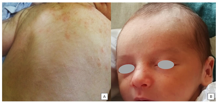 Figure 3 Common rashes