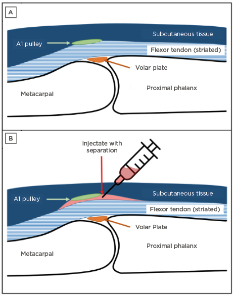 Figure 1 Schematic of the metacarpophalangeal joint with A) surrounding soft tissue structures and B) separation after