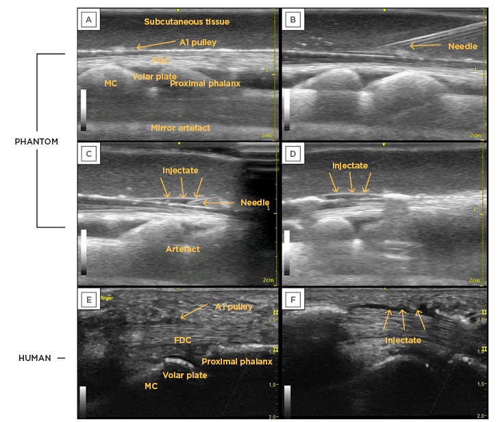 Figure 3 Pre- and post-injection ultrasound images of the 3D-printed phantom compared to a