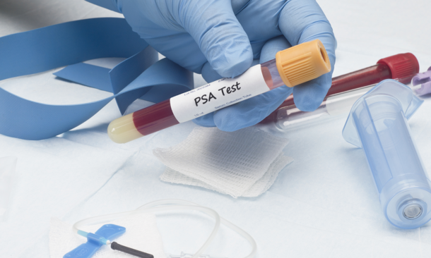 Prostate specific antigen PSA blood culture sample with catheter and collection tubes.