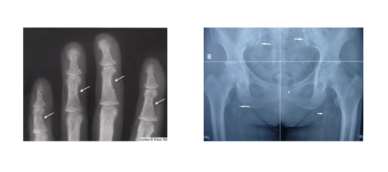 Figure 2 Consequences of secondary hyperparathyroidism