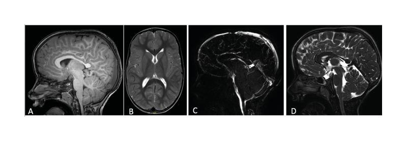 Figure 2 A–B) T1 sagittal and T2-weighted axial magnetic resonance brain images show a cranial deformity in the context of an early closure of the sagittal suture