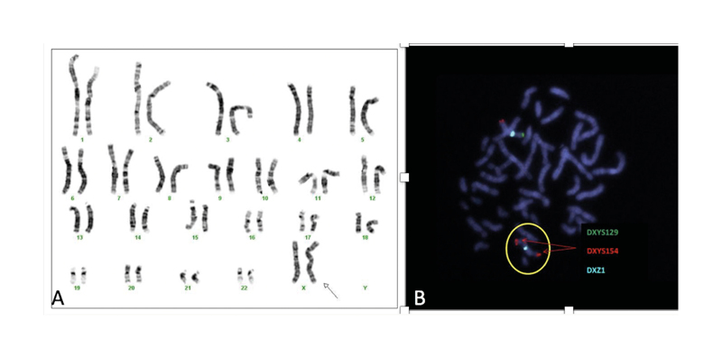 Figure 3 A) Karyotype of the patient, a non-mosaic 45,X,i (X)(q10); B) fluorescence in situ hybridisation showing a metaphase with two X chromosomes (DXZ1x2)