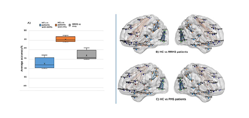 Figure 1 Results from machine-learning tool to classify patients with relapsing-remitting multiple sclerosis and progressive multiple sclerosis from healthy controls