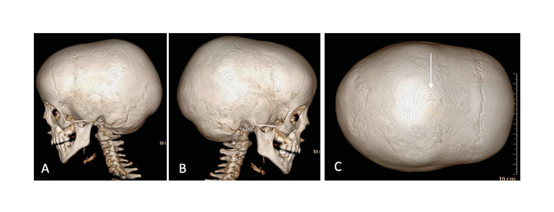 Figure 1 CT scan with 3D reconstruction showing A–B) lateral view; C vertex view