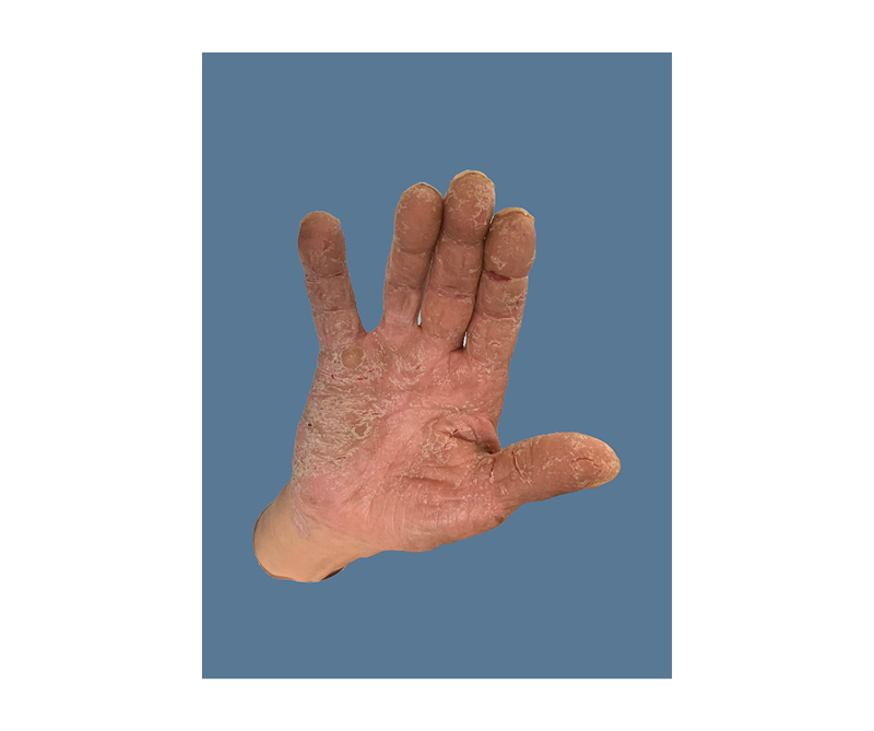 Figure 1 Necrolytic acral erythema affecting the right hand