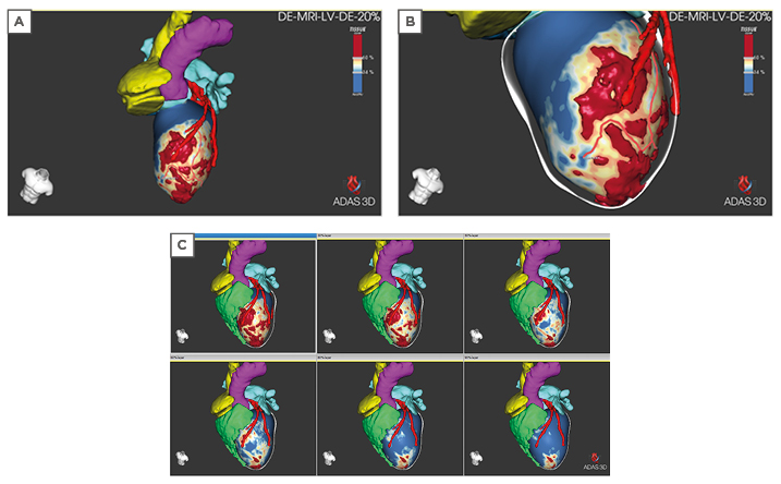 Figure 1 3D visualisation of extent of scarring