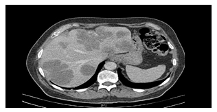 Figure 2 Pre-operative chemotherapy CT scan of colorectal liver metastases (with consent)