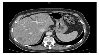 Figure 3 CT scan post-chemotherapy of colorectal liver metastases (with consent)