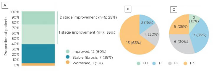 Figure 2 Effect of AramcholTM on fibrosis stage in the n=20 cohort.