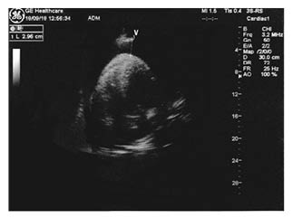 Figure 1 An echocardiogram at the entrance showing haemopericardium on an apical four chamber view.