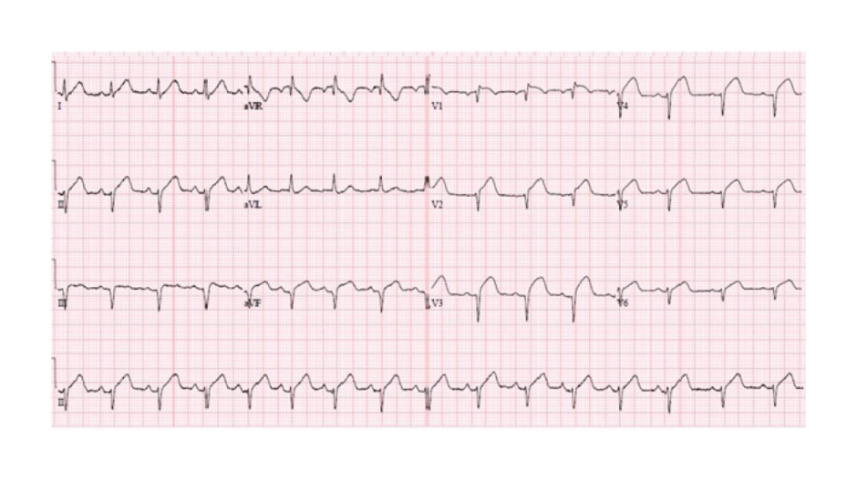Figure-1-An-ECG-presentation-showing-ST-segment-elevation-in-anterolateral-and-inferior-leads