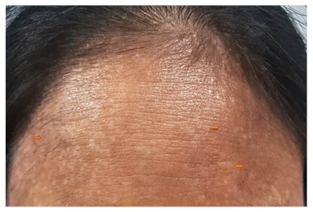 Figure 1 Multiple hypopigmented flat-topped papules and plaques present over the forehead (o