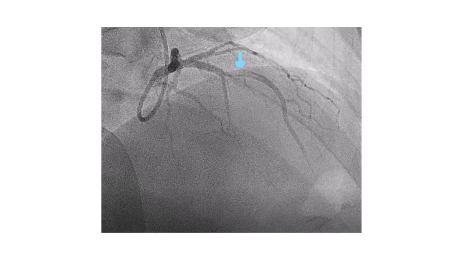 Figure-2-An-angiogram-from-the-right-anterior-oblique-cranial-projection-showing-a-thrombotic-occlusion
