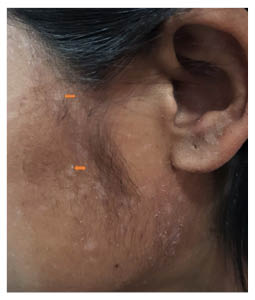 Figure 2 Multiple hypopigmented macules with scaling present over the lateral side of the fa