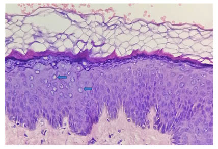 Figure 3 A histologic analysis of the forehead with a punch biopsy showed basket-weave hyper