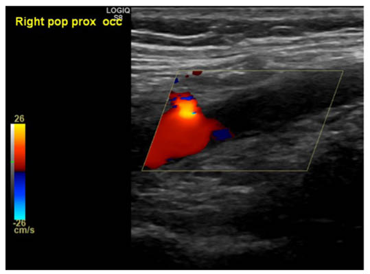 Figure 3 Ultrasound right lower limb with Doppler flow