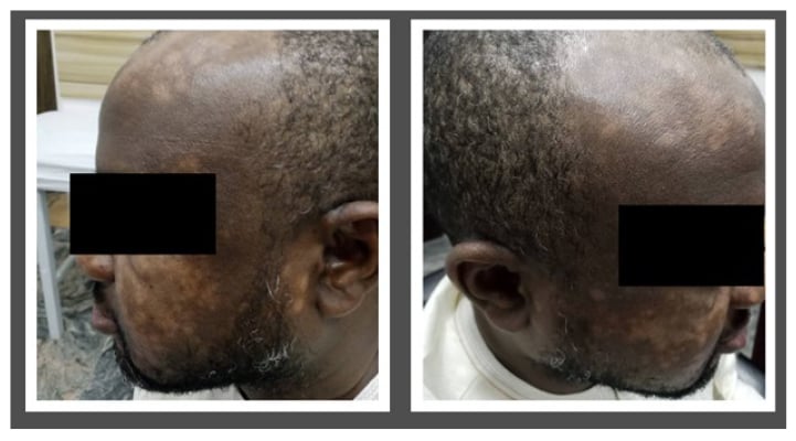 Facial manifestation of vitiligo with multiple hypopigmentations