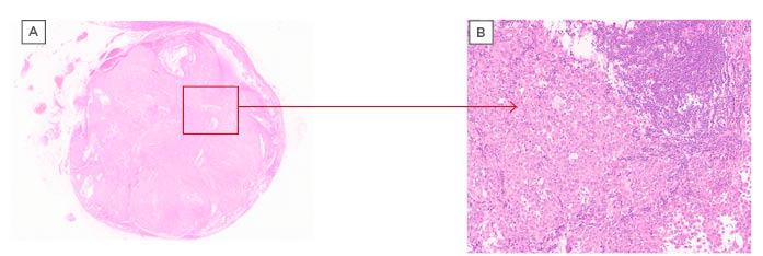 Figure 1 Photographs of the patient’s acute sunburns, characterised by diffuse erythema