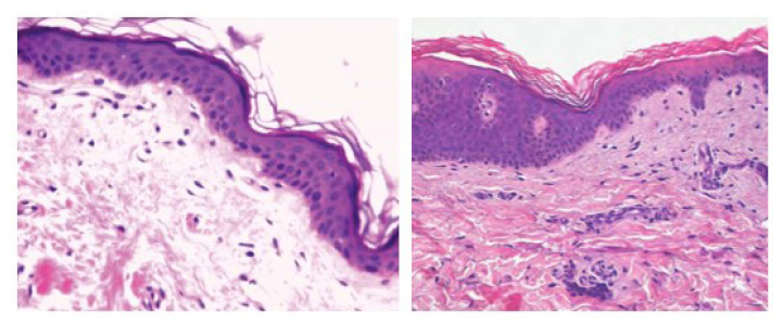 Histopathological features of vitiligo like hypopigmentation, showing irregular epidermal hyperplasia