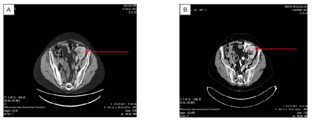 Figure 4 Anteroposterior abdominal CT scans showing the renal graft (indicated by the arrow) before (A) and after (B)