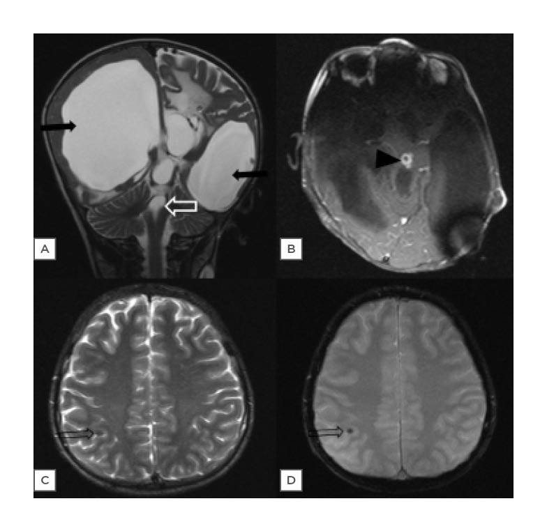 Figure 1: Spectrum of intracranial infections.