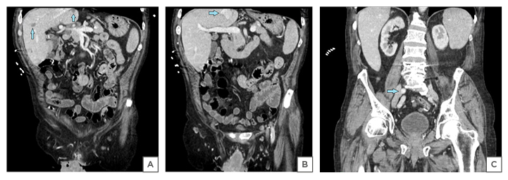 Figure 1A Coronal sections of CT abdomen and pelvis